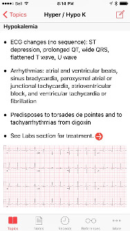 Hypokalemia - ECG